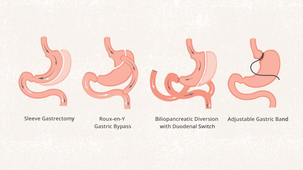 a-complete-guide-to-bariatric-surgery-1440x810-1-1024x576.jpg